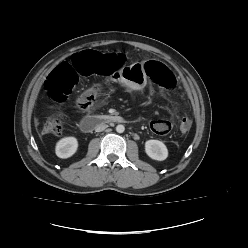 Acute mesenteric ischemia - superior mesenteric artery thrombosis (Radiopaedia 73947-84776 Axial C+ portal venous phase 59).jpg