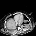 Acute pancreatic necrosis (Radiopaedia 13560-18501 Axial C+ portal venous phase 1).jpg