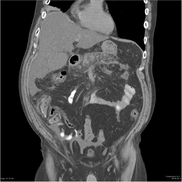 File:Acute pancreatitis (Radiopaedia 19135-19116 Coronal non-contrast 13).jpg