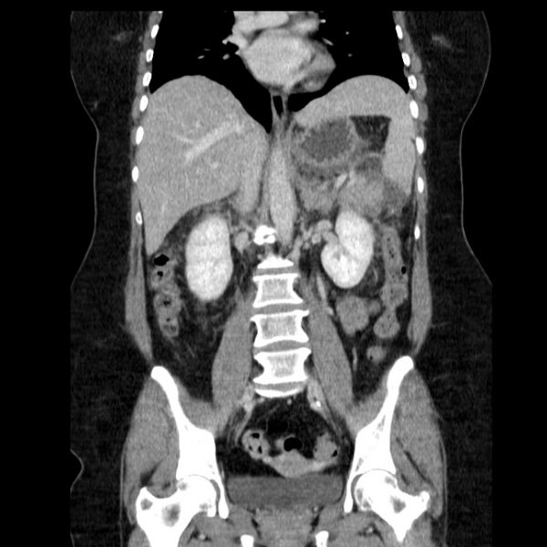 File:Acute pancreatitis - Balthazar C (Radiopaedia 26569-26714 Coronal C+ portal venous phase 39).jpg