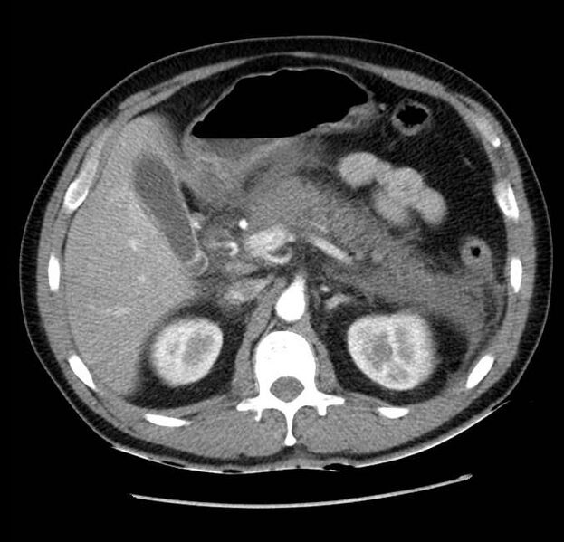 File:Acute pancreatitis - Balthazar E (Radiopaedia 23080-23110 Axial C+ arterial phase 22).jpg
