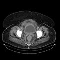 Acute pyelonephritis (Radiopaedia 25657-25837 Axial renal parenchymal phase 73).jpg