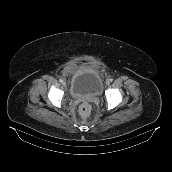 File:Acute pyelonephritis (Radiopaedia 25657-25837 Axial renal parenchymal phase 73).jpg
