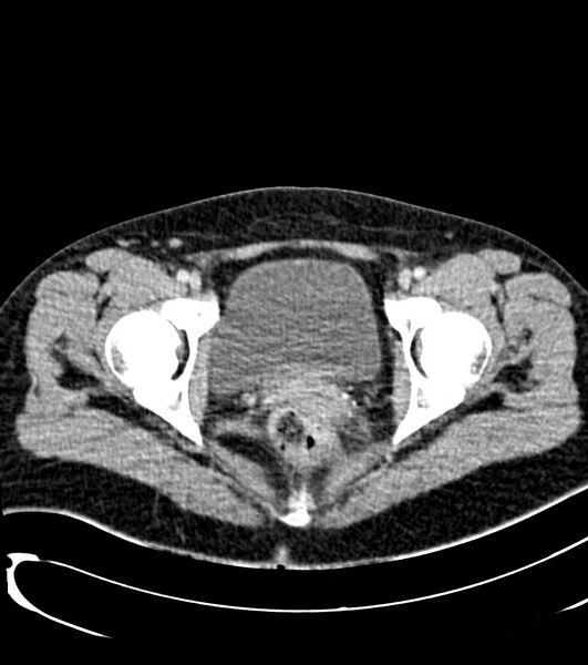 File:Acute pyelonephritis (Radiopaedia 40264-42816 Axial C+ portal venous phase 59).jpg