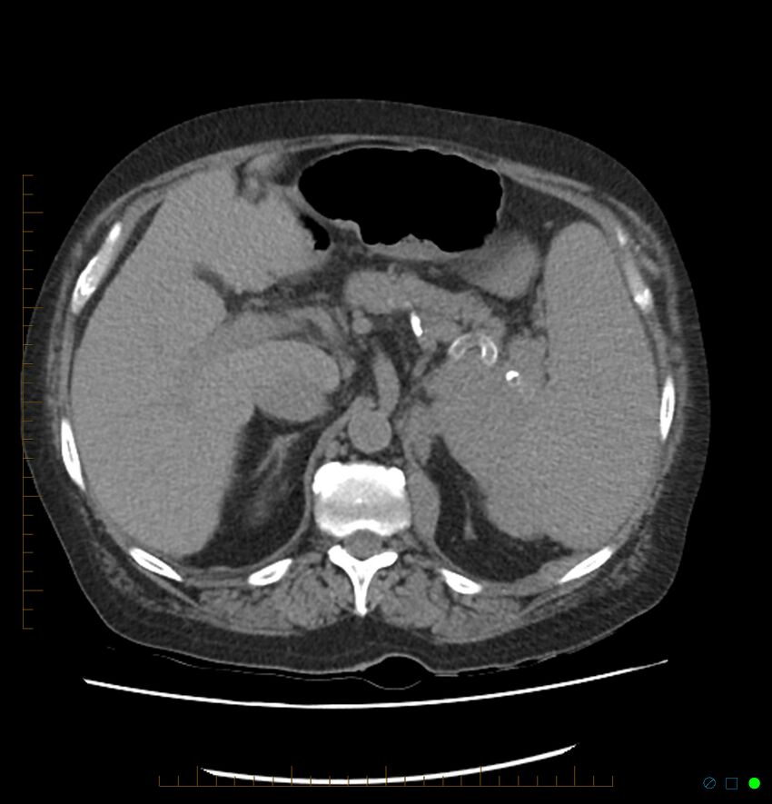 Acute renal failure post IV contrast injection- CT findings (Radiopaedia 47815-52557 Axial non-contrast 23).jpg