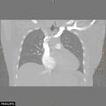 Acute reversible pulmonary hypertension and right heart failure from cocaine toxicity (Radiopaedia 49394-54517 Coronal C+ CTPA 18).jpg