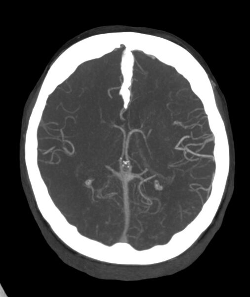 File:Acute right MCA M1 occlusion (Radiopaedia 62268-70454 Axial Phase 1 13).jpg