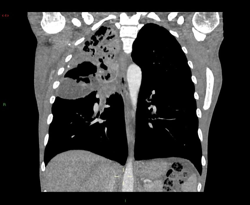 Acute right lung abscess (Radiopaedia 34806-36258 Coronal C+ arterial phase 23).jpg