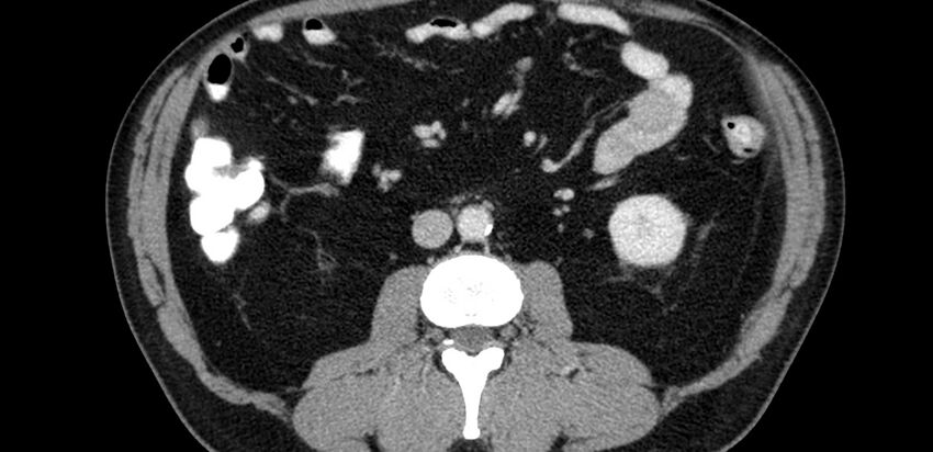 Acute sigmoid colon diverticulitis (Radiopaedia 55507-61976 Axial C+ portal venous phase 14).jpg