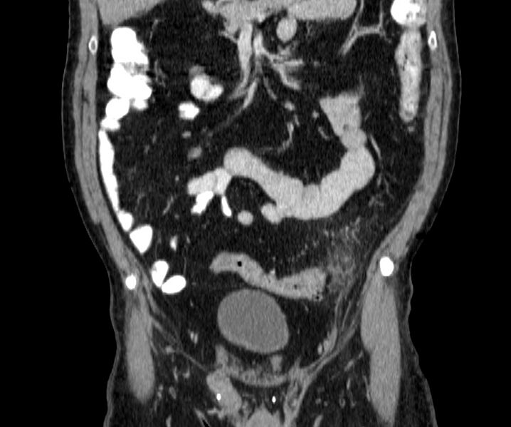 File:Acute sigmoid colon diverticulitis (Radiopaedia 55507-61976 Coronal C+ portal venous phase 48).jpg