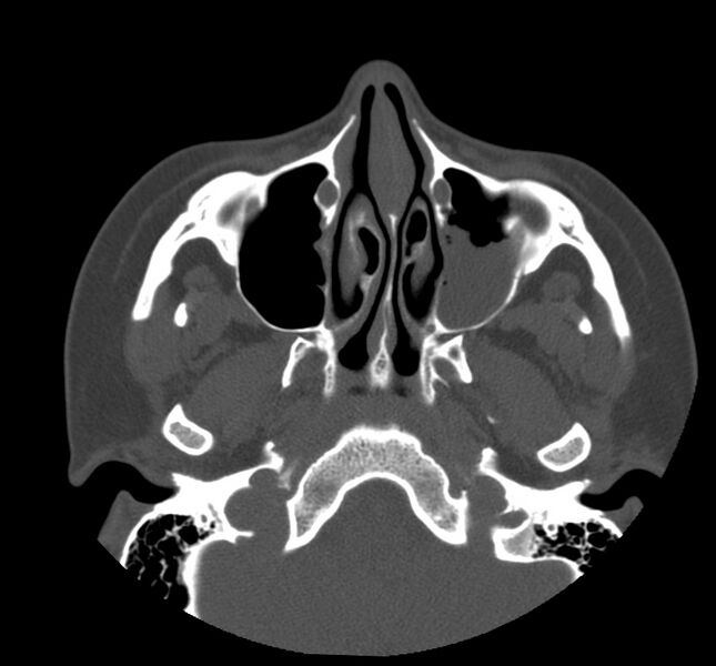 File:Acute sinusitis (Radiopaedia 22419-22455 Axial non-contrast 13).jpg