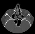 Acute sinusitis (Radiopaedia 23161-23215 Axial bone window 36).jpg