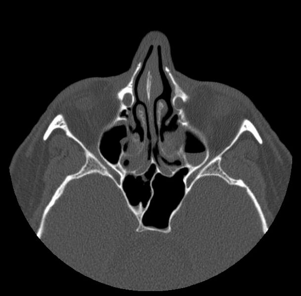 File:Acute sinusitis (Radiopaedia 23161-23215 Axial bone window 36).jpg