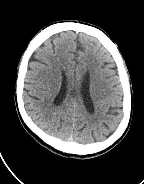 File:Acute superior cerebellar artery territory infarct (Radiopaedia 84104-99359 Axial non-contrast 28).jpg