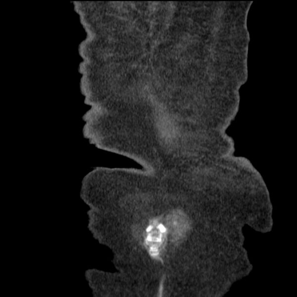 File:Acute tubular necrosis (Radiopaedia 28077-28334 D 79).jpg