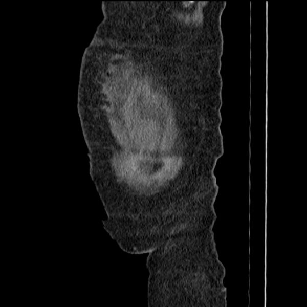 File:Acute tubular necrosis (Radiopaedia 28077-28334 Sagittal non-contrast 6).jpg