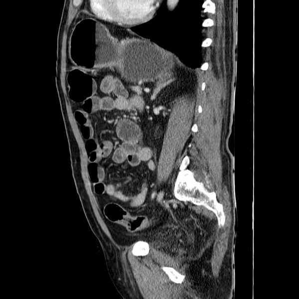 File:Adenocarcinoma of colon with entero-colic fistula (Radiopaedia 22832-22852 Sagittal C+ portal venous phase 41).jpg