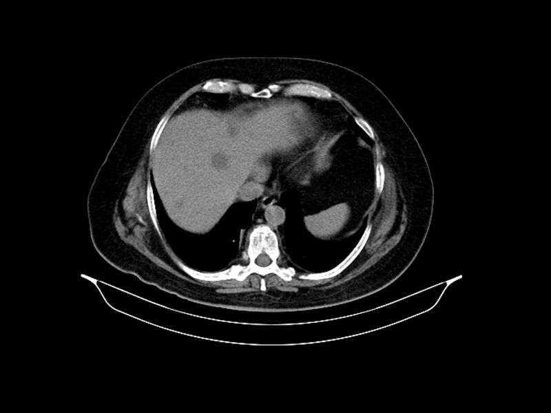 File:Adenocarcinoma of pancreas with hepatic metastasis (Radiopaedia 64332-73122 Axial non-contrast 17).jpg