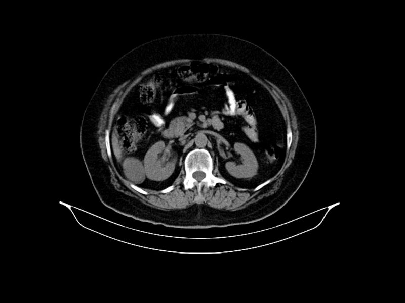 File:Adenocarcinoma of pancreas with hepatic metastasis (Radiopaedia 64332-73122 Axial non-contrast 42).jpg