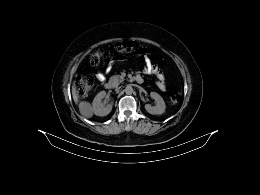 Adenocarcinoma of pancreas with hepatic metastasis (Radiopaedia 64332-73122 Axial non-contrast 42).jpg