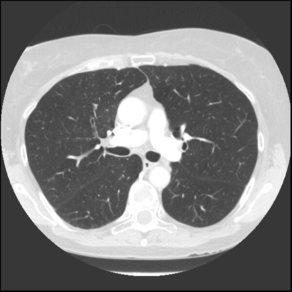 File:Adenocarcinoma of the lung (Radiopaedia 41015-43755 Axial lung window 50).jpg