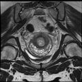 Adenoma malignum of the cervix (Radiopaedia 24460-24765 Coronal T2 17).jpg