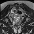 Adenoma malignum of the cervix (Radiopaedia 24460-24765 Coronal T2 24).jpg