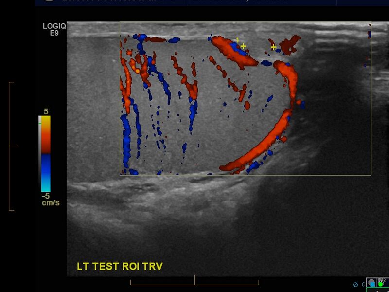File:Adenomatoid tumor of the testicular tunica (Radiopaedia 30695-31388 Duplex 1).jpg