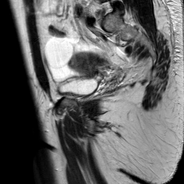 File:Adenomyoma of the uterus (Radiopaedia 9871-10439 Sagittal T2 8).jpg