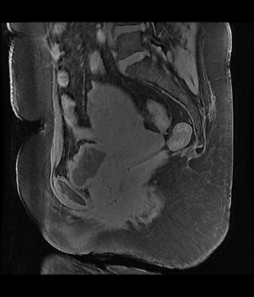 File:Adenomyosis - diffuse (Radiopaedia 65072-74065 Sagittal T1 C+ fat sat 7).jpg