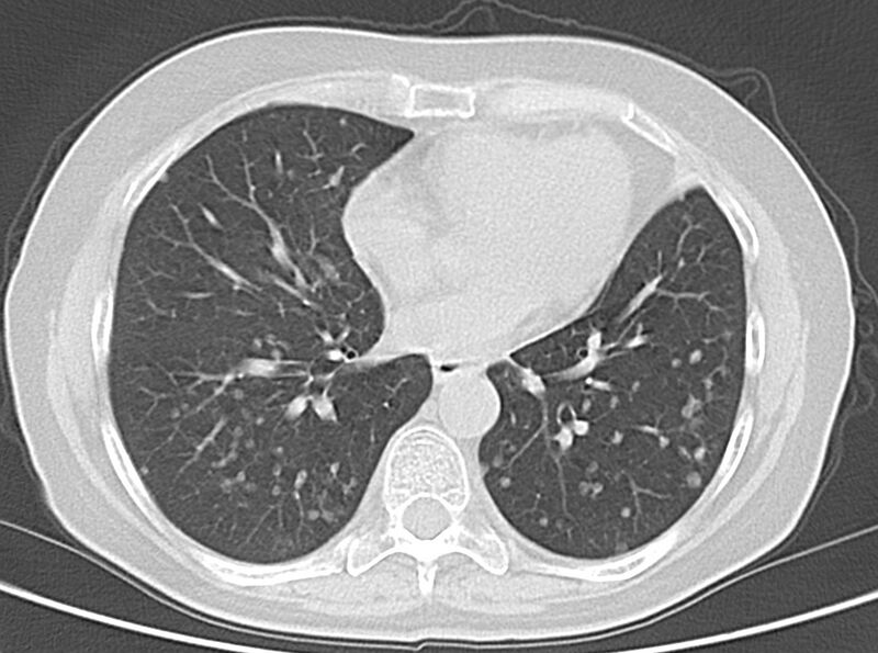 File:Adenosquamous lung carcinoma (Radiopaedia 22035-22030 lung window 38).jpg