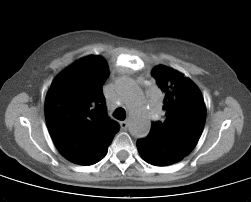 Adenosquamous lung carcinoma (Radiopaedia 22035-22030 non-contrast 24).jpg
