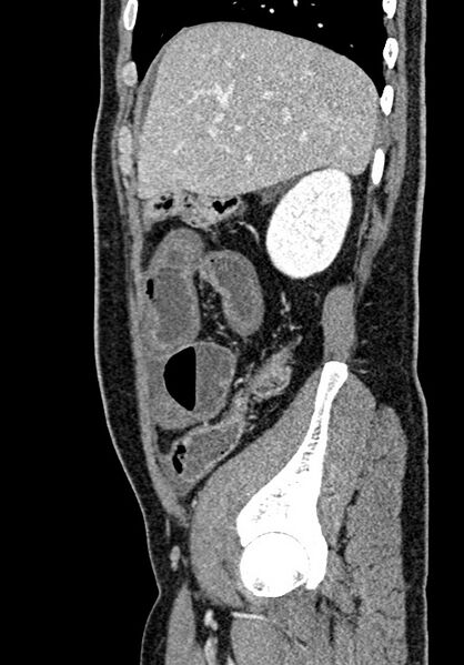 File:Adhesional small bowel obstruction (Radiopaedia 58900-66131 Sagittal C+ portal venous phase 61).jpg