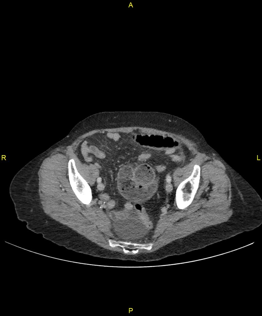 Adhesional small bowel obstruction (Radiopaedia 85402-101024 Axial C+ portal venous phase 238).jpg