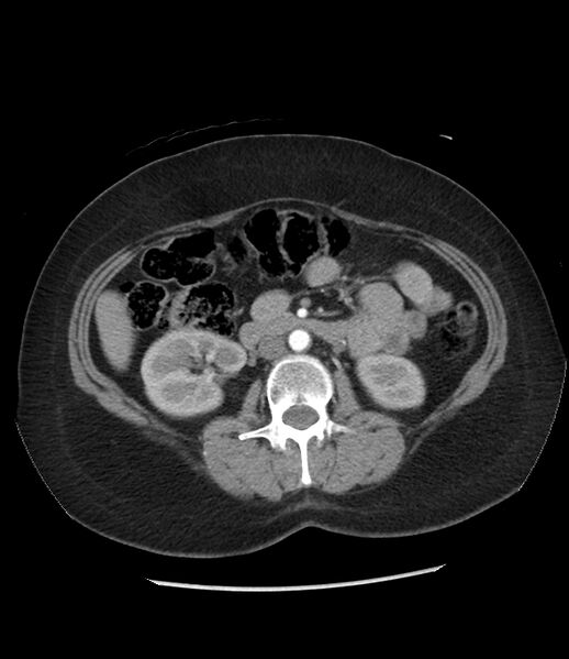 File:Adrenal cortical carcinoma with IVC invasion and thrombosis (Radiopaedia 34307-35597 Axial C+ arterial phase 42).jpg
