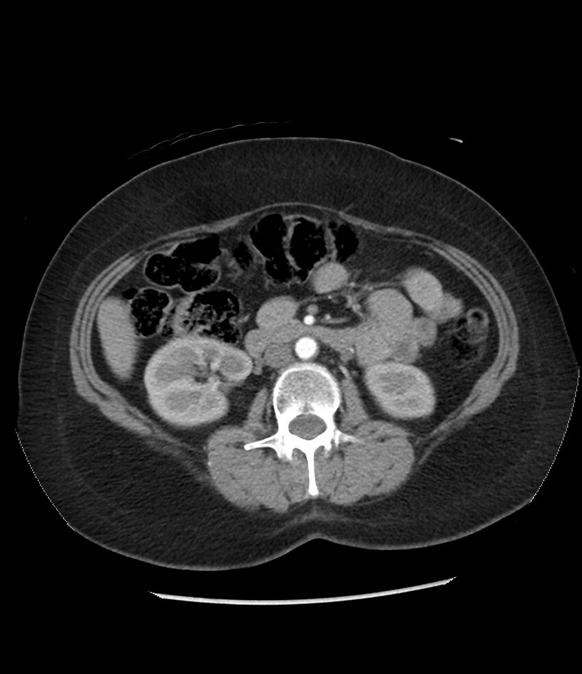 Adrenal cortical carcinoma with IVC invasion and thrombosis (Radiopaedia 34307-35597 Axial C+ arterial phase 42).jpg