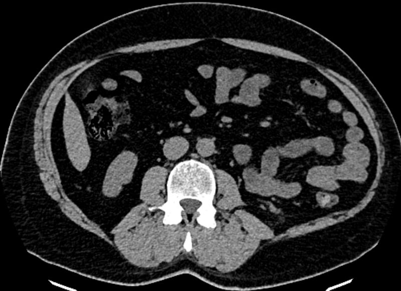 File:Adrenal metastases (Radiopaedia 73082-83791 Axial non-contrast 97).jpg