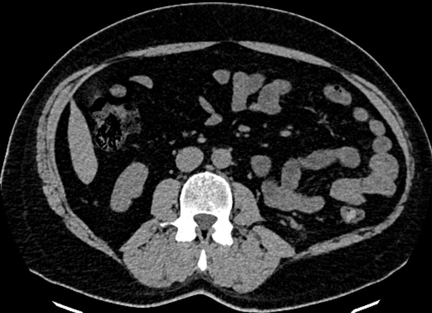 Adrenal metastases (Radiopaedia 73082-83791 Axial non-contrast 97).jpg