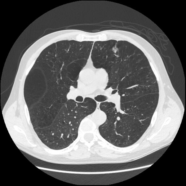 File:Alpha-1-antitrypsin deficiency (Radiopaedia 40993-43722 Axial lung window 106).jpg