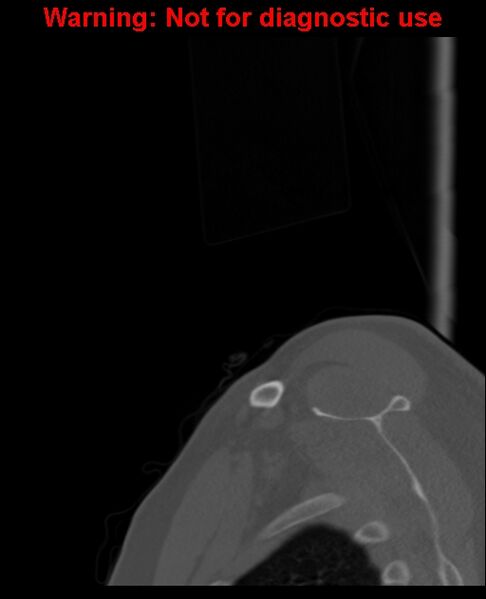 File:Ameloblastoma (Radiopaedia 33126-34164 Sagittal bone window 4).jpg