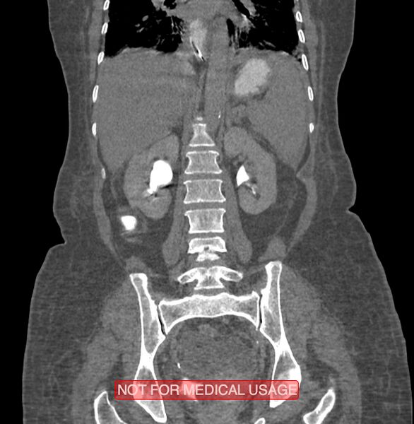 File:Amoebic enterocolitis with liver abscess (Radiopaedia 35100-36609 B 133).jpg