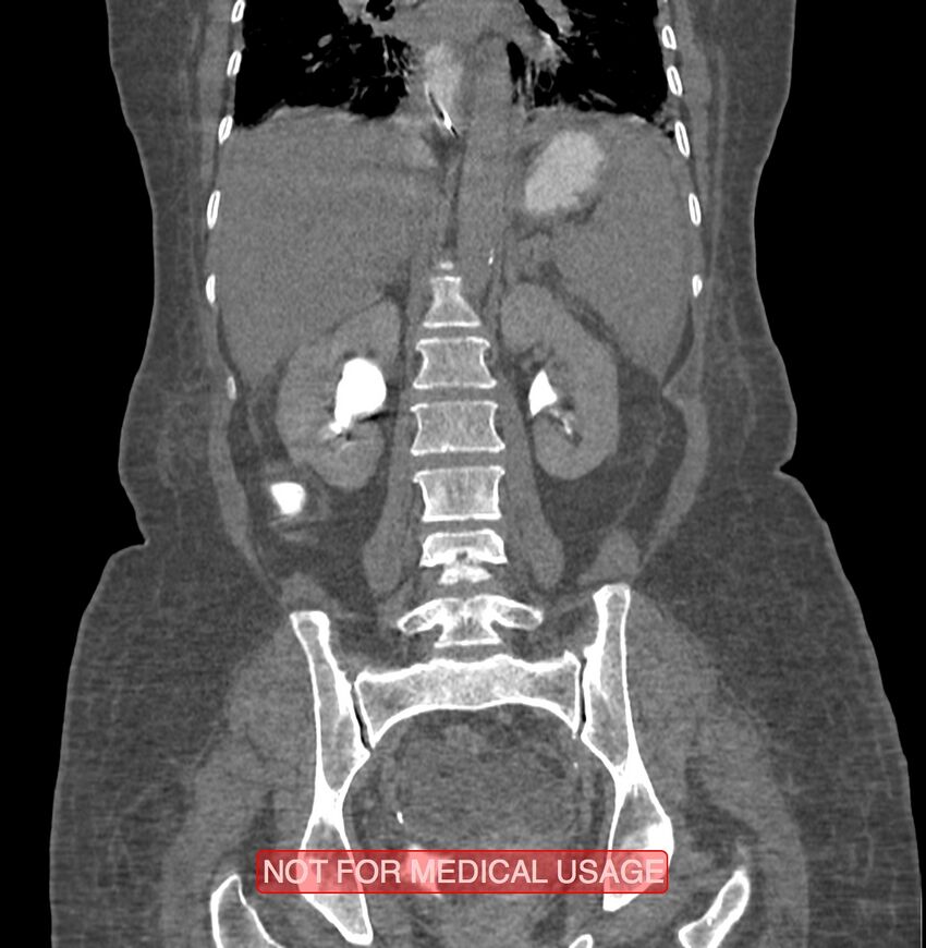 Amoebic enterocolitis with liver abscess (Radiopaedia 35100-36609 B 133).jpg