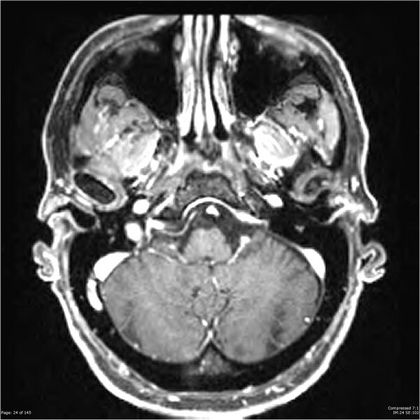 File:Anaplastic meningioma with recurrence (Radiopaedia 34452-35788 Axial T1 C+ 24).jpg