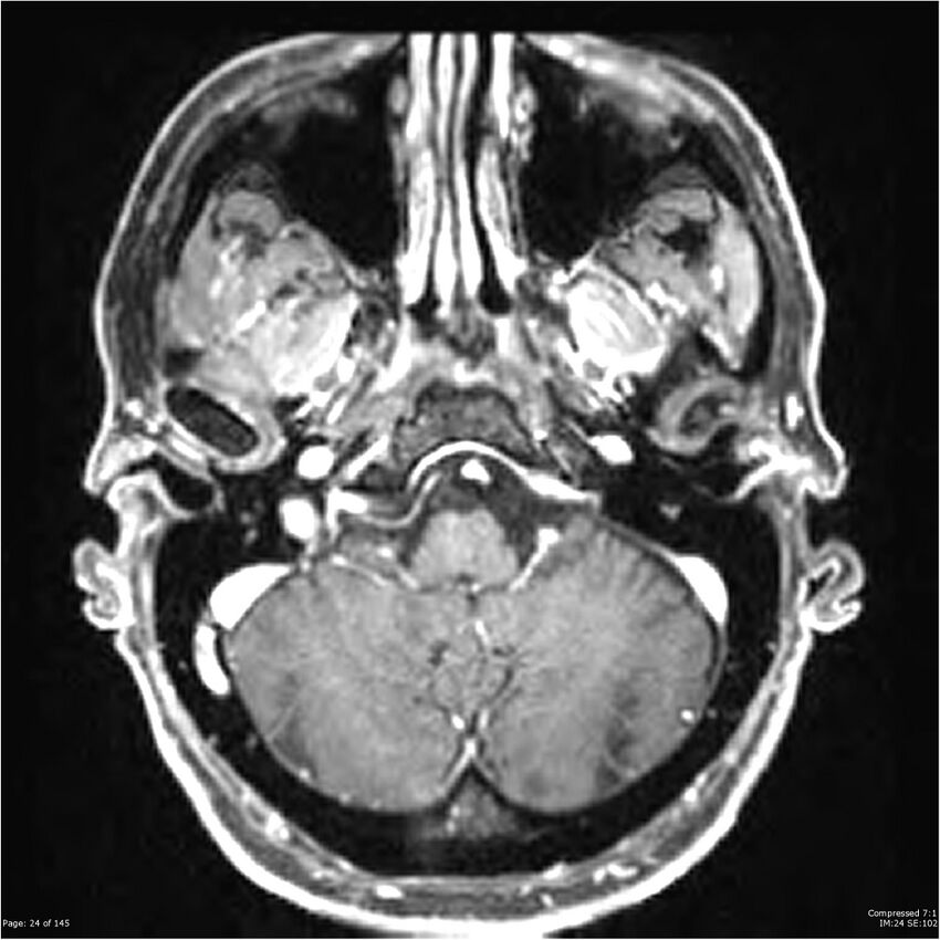 Anaplastic meningioma with recurrence (Radiopaedia 34452-35788 Axial T1 C+ 24).jpg