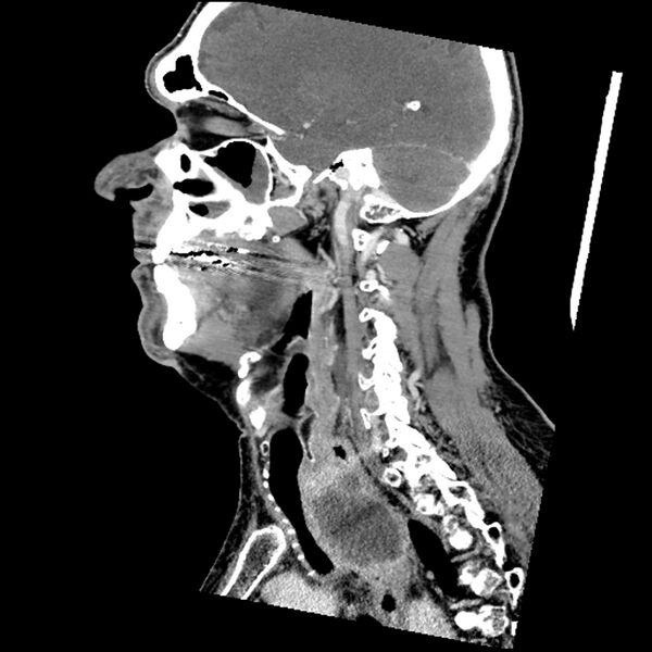 File:Anaplastic thyroid carcinoma (Radiopaedia 79087-92034 C 58).jpg