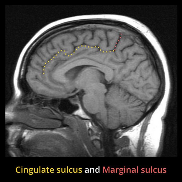 File:Anatomy- sulci of the brain (Radiopaedia 33834-34995 Marginal sulcus 2).jpg