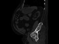 Ankylosing spondylitis (Radiopaedia 44609-48357 Sagittal bone window 78).jpg