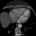Anomalous origin of left circumflex artery from right coronary sinus (Radiopaedia 72563-83117 B 128).jpg