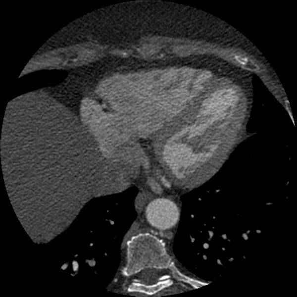 File:Anomalous origin of left circumflex artery from right coronary sinus (Radiopaedia 72563-83117 B 135).jpg