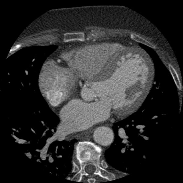 File:Anomalous origin of left circumflex artery from right coronary sinus (Radiopaedia 72563-83117 B 81).jpg